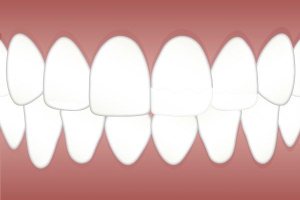 Bonding zębów – co to jest?