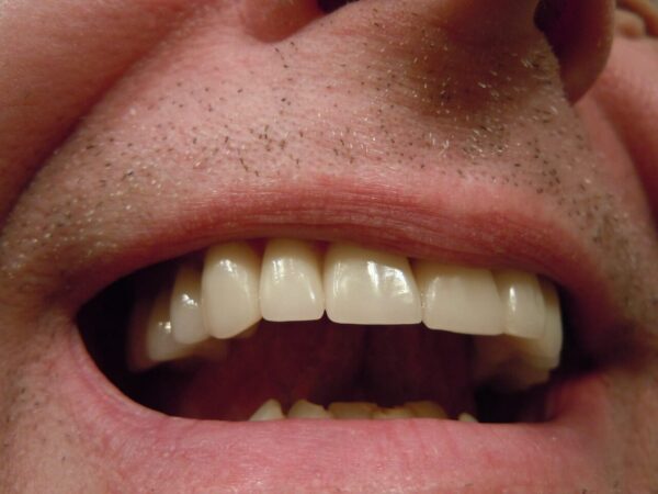 Szary ząb po leczeniu kanałowym